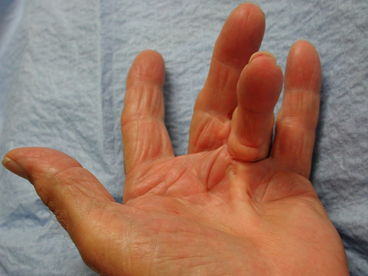 Dupuytren's Disease patient treatment Lakeland orthopaedic hand surgery
